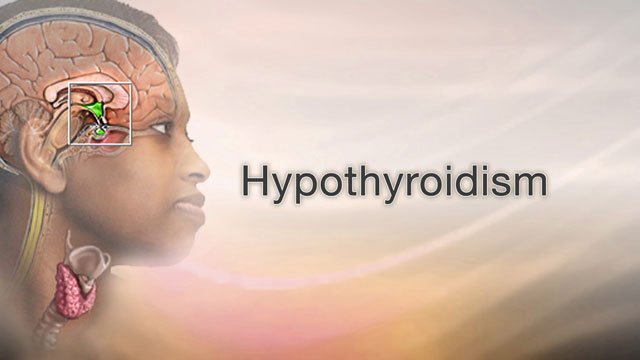 Treatment From Hypothyroidism - Hypothyroidism